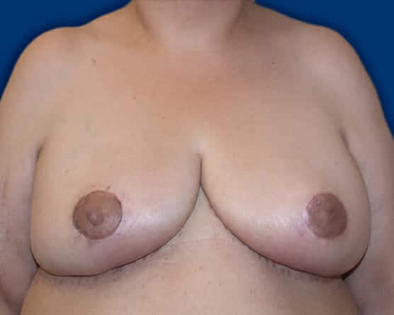 breast reduction 1438 - Patient 15