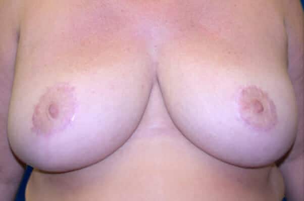 breast reduction 1441 - Patient 19