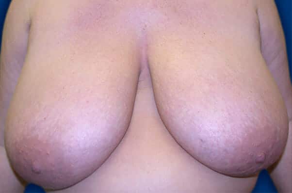 breast reduction 1442 - Patient 19