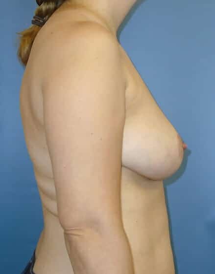 breast reduction 1484 - Patient 13