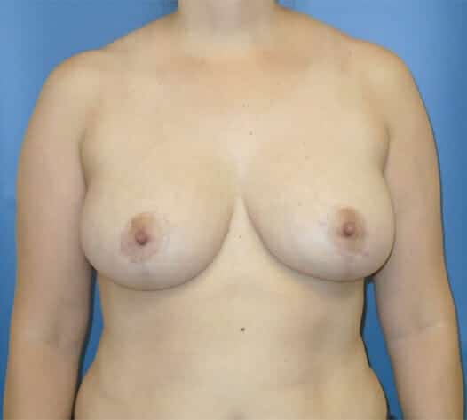 breast reduction 1485 - Patient 13