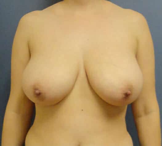 breast reduction 1486 - Patient 13