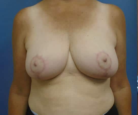 breast reduction 1652 - Patient 12
