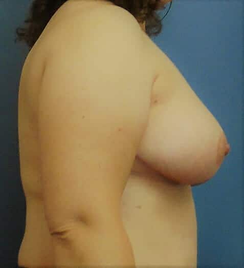 breast reduction 1787 - Patient 10