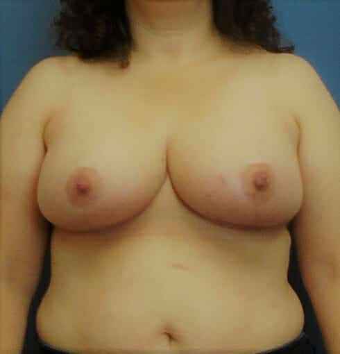 breast reduction 1789 - Patient 10