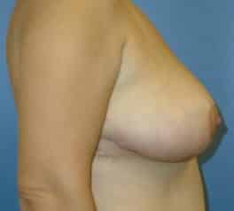 breast reduction 2186 - Patient 20