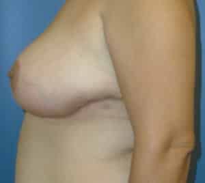 breast reduction 2191 - Patient 20