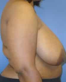 breast reduction 2204 - Patient 21