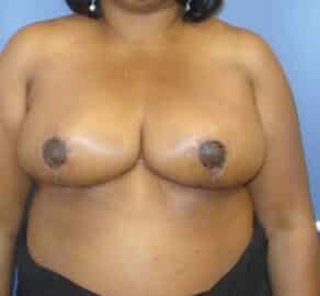 breast reduction 2205 - Patient 21