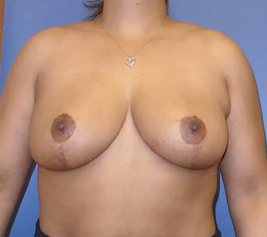 breast reduction 2882 - Patient 14