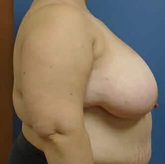 breast reduction 3726 - Patient 6