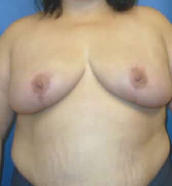breast reduction 3727 - Patient 6