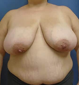 breast reduction 3728 - Patient 6