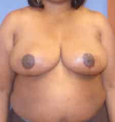 breast reduction 3754 - Patient 5
