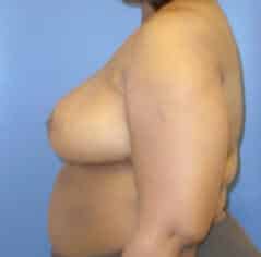 breast reduction 3756 - Patient 5