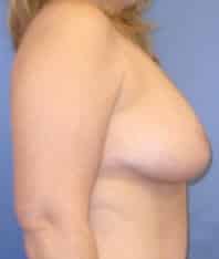 breast reduction 3838 - Patient 4