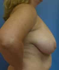 breast reduction 3839 - Patient 4