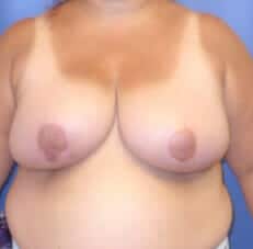 breast reduction 3924 - Patient 3