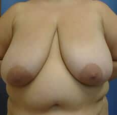 breast reduction 3925 - Patient 3