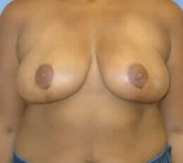 breast reduction 3932 - Patient 2