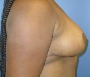 breast reduction 3935 - Patient 2