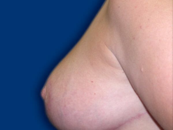 breast reduction 662 - Patient 7