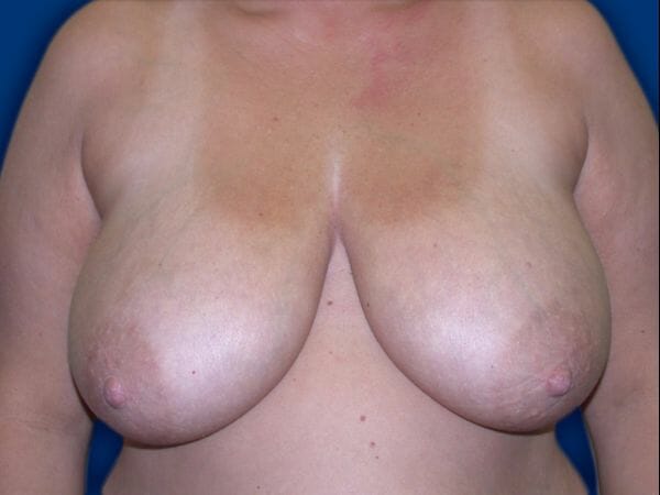 breast reduction 663 - Patient 7