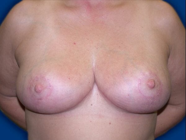 breast reduction 664 - Patient 7