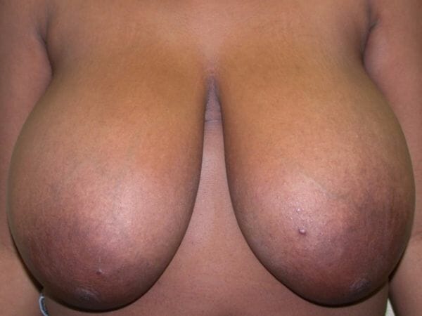 breast reduction 671 - Patient 9