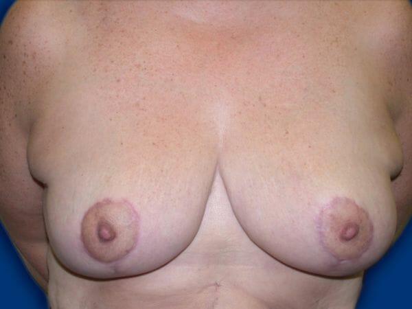 breast reduction 677 - Patient 11