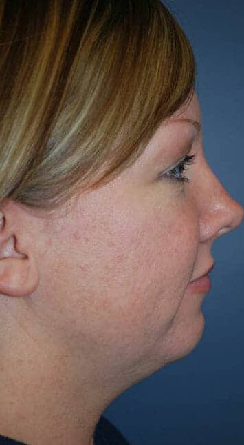 chin neck liposuction 3071 - Patient 1