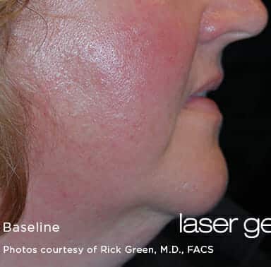 laser genesis 3204 - Patient 7