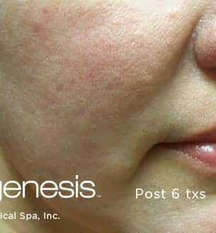 laser genesis 3213 - Patient 4