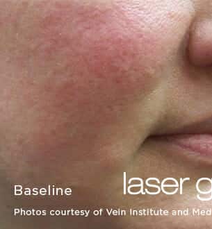 laser genesis 3214 - Patient 4