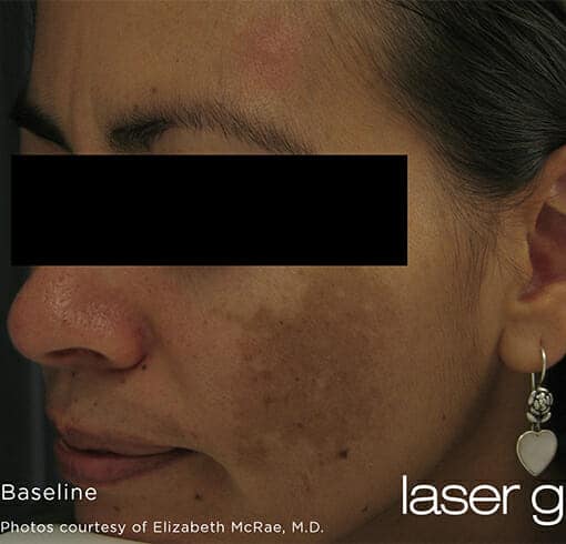 laser genesis 3216 - Patient 3