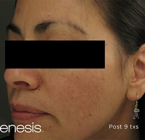 laser genesis 3217 - Patient 3