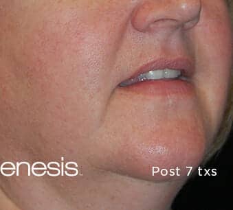 laser genesis 3220 - Patient 2