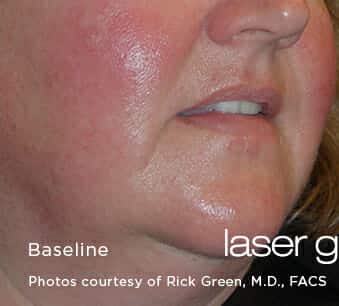 laser genesis 3221 - Patient 2