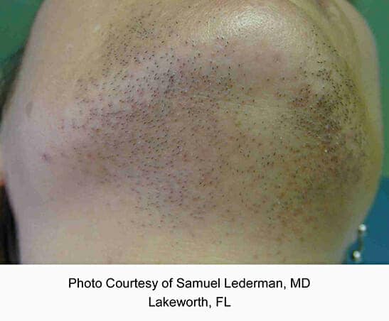 laser hair removal 3189 - Patient 4