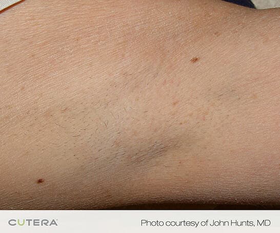 laser hair removal 3191 - Patient 3