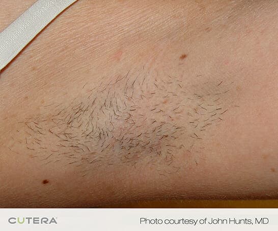 laser hair removal 3192 - Patient 3