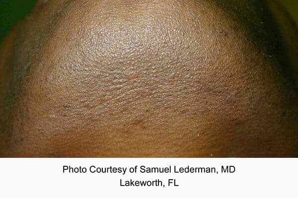 laser hair removal 3195 - Patient 2