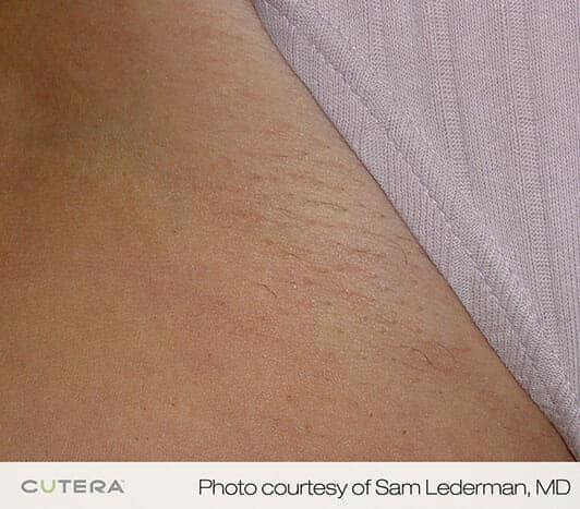 laser hair removal 3198 - Patient 1