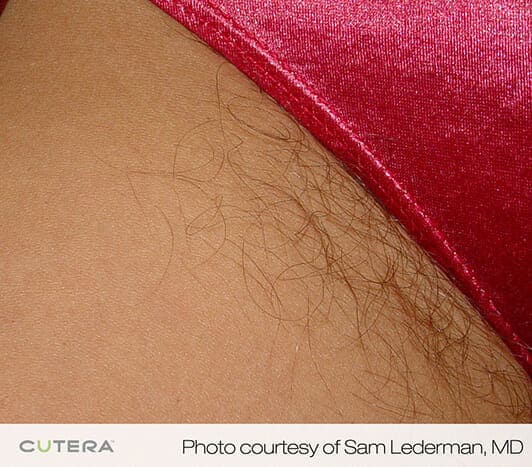 laser hair removal 3199 - Patient 1