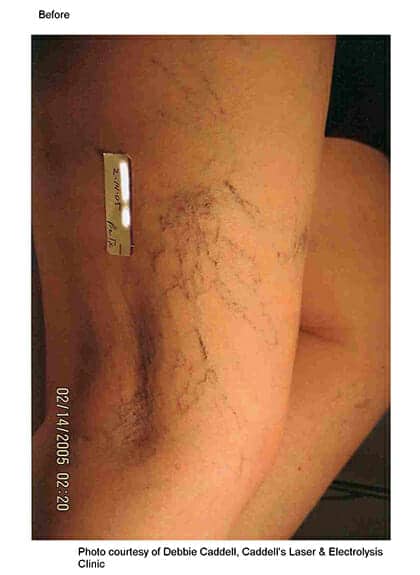 laser vein removal 3176 - Patient 3
