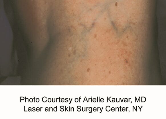 laser vein removal 3185 - Patient 1