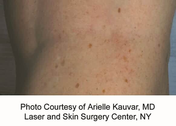 laser vein removal 3186 - Patient 1