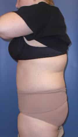 liposuction 1454 - Patient 7