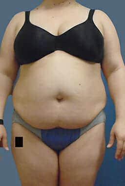 liposuction 1456 - Patient 7
