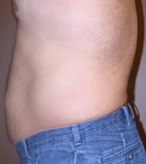 liposuction 1617 - Patient 9